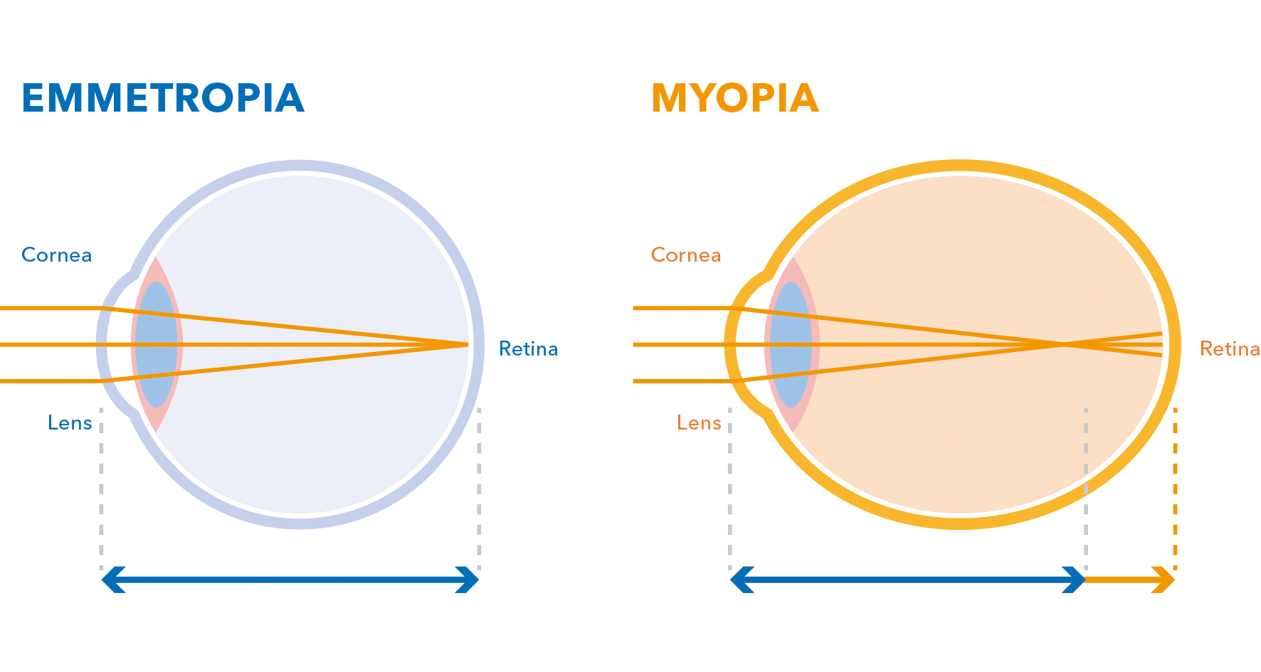 MIOPIA1